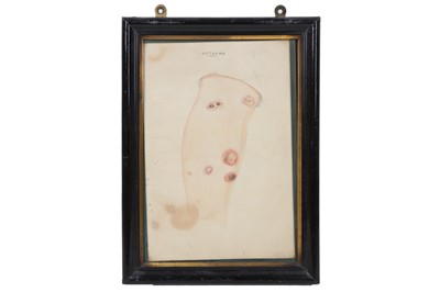 Lot 164 - A SET OF TEN LATE 19TH CENTURY DETAILED WATERCOLOURS OF HUMAN SKIN DISEASES